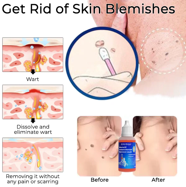 WartsOff Instant Blemish Removal Liquid