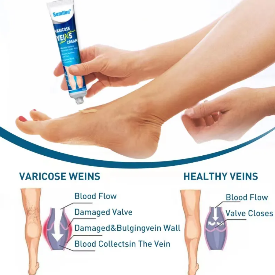 Varicose Veins Ointment - Buy 1 Get 1 Free