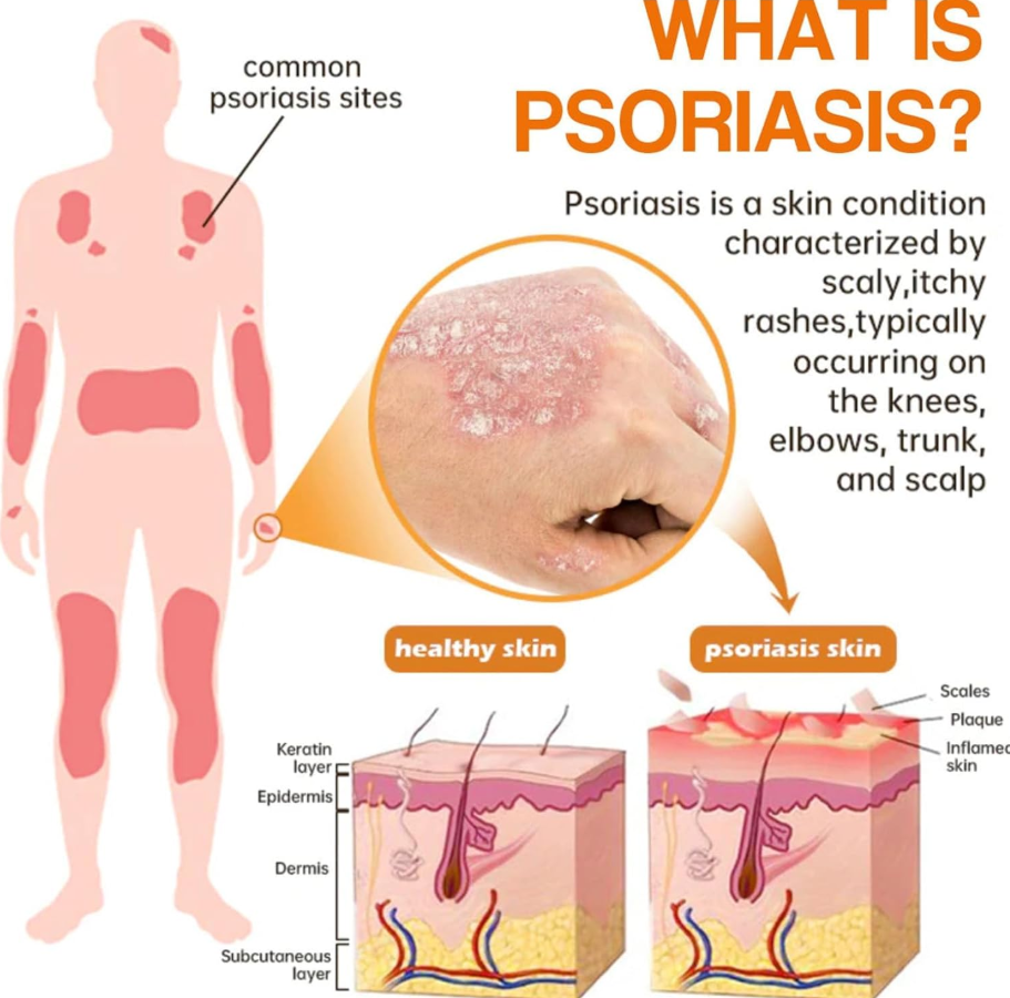 BeeVenom Psoriasis Care Spray Pro