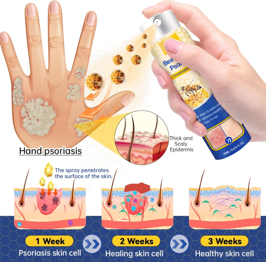 BeeVenom Psoriasis Care Spray Pro