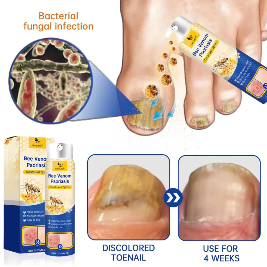 BeeVenom Psoriasis Care Spray Pro
