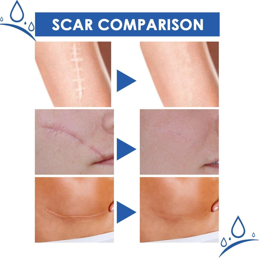 Professional Scar Removal Gel