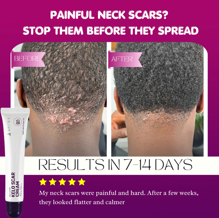 Kelo Scar Cream