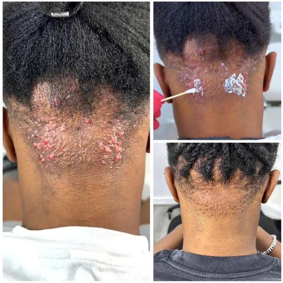 Kelo Scar Cream