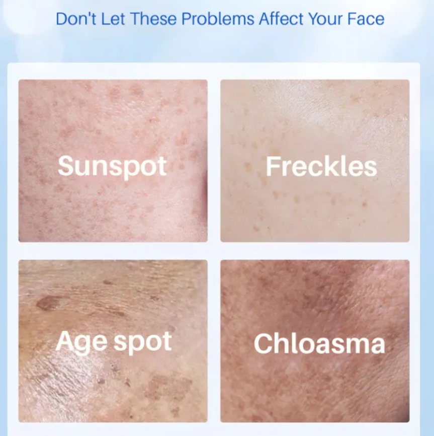 Age Spot Essence Milk Improve Skin Pigmentation Yello Essence Cream