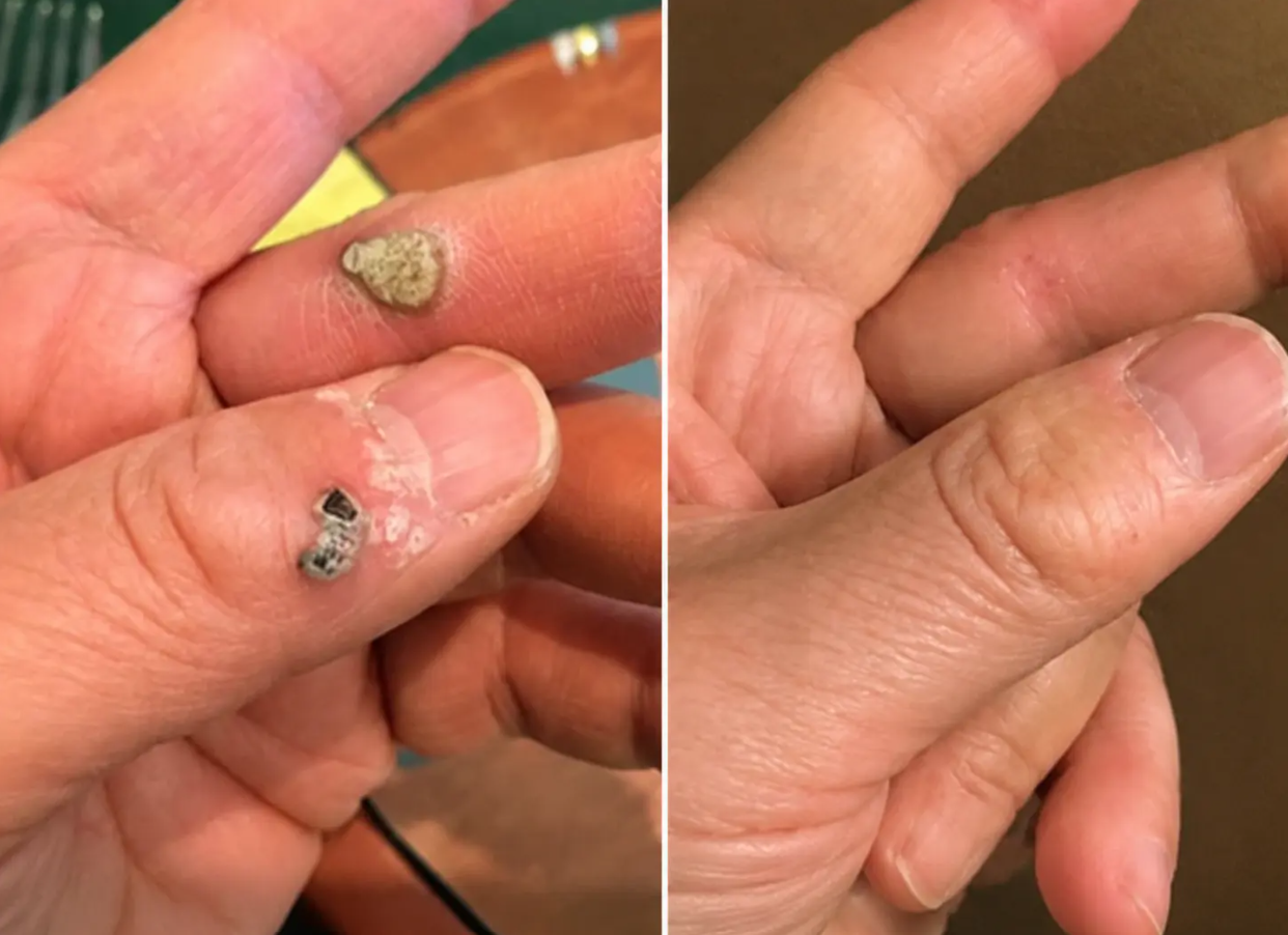 2-in-1 Microneedle & Hydrocolloid Patch
