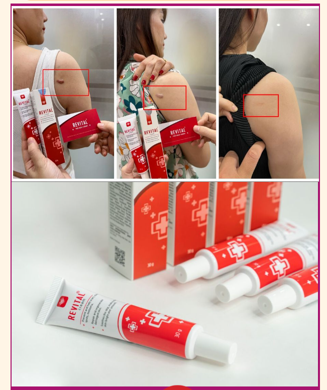 Revital Scar Treatment Cream