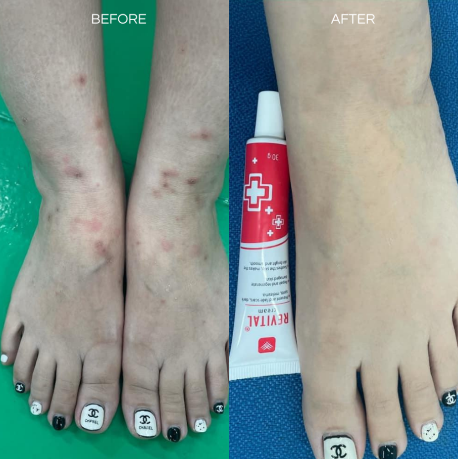 Revital Scar Treatment Cream